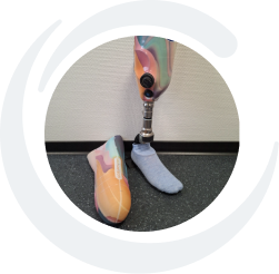 Beinprothese und Liner von APT Prothesen Kundin Karin